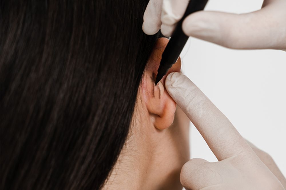 Kepçe Kulak Estetiği görseli