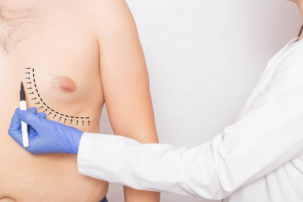 Jinekomasti (Erkek meme estetiği) görseli