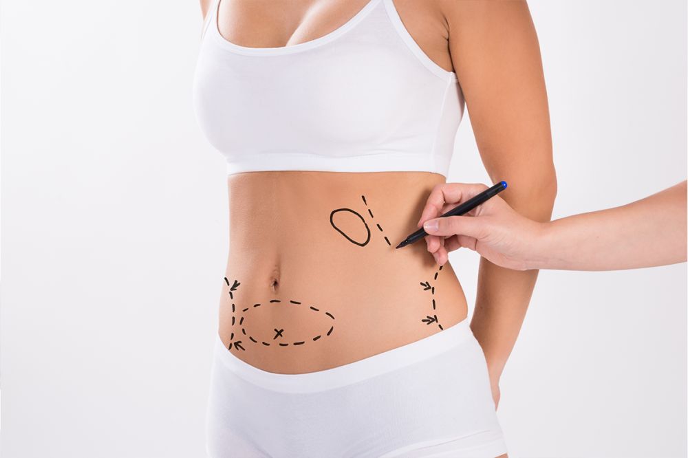 Liposuction ile vücut şekillendirme görseli