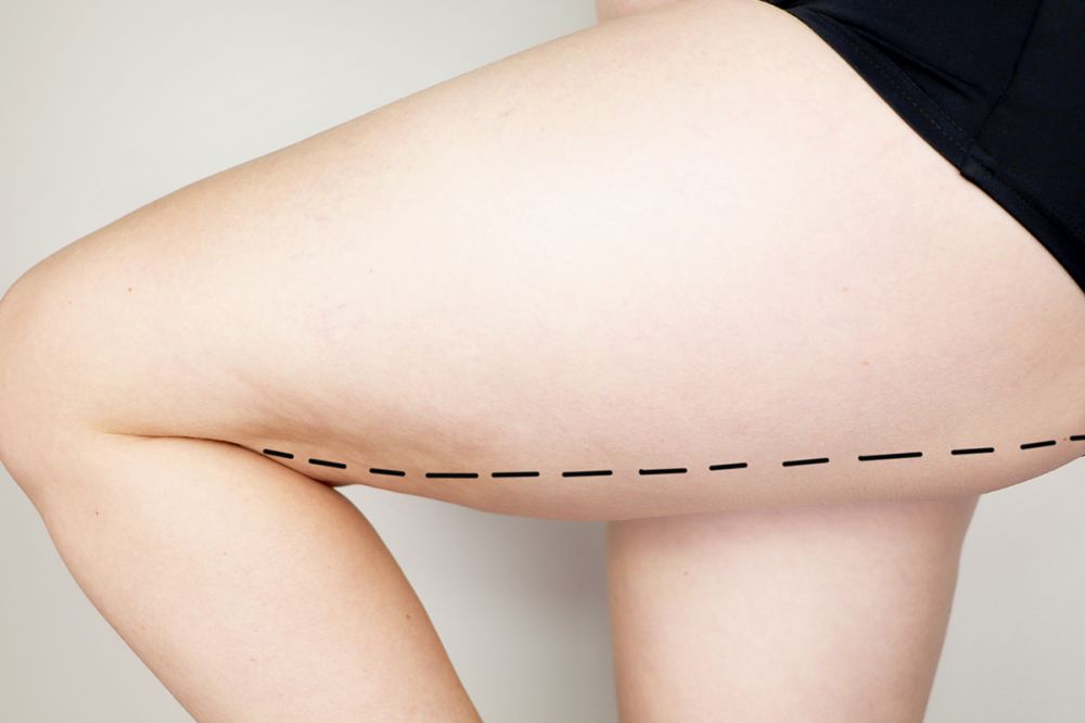 Uyluk Germe görseli