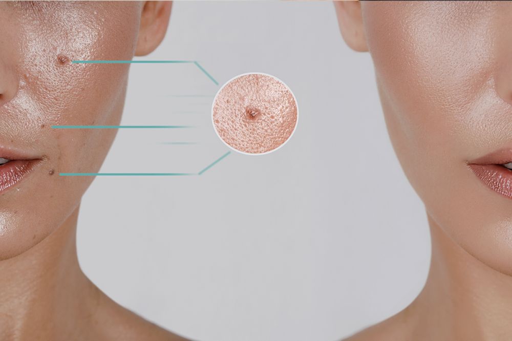 Ben Alımı (Nevüs Eksizyonu) görseli